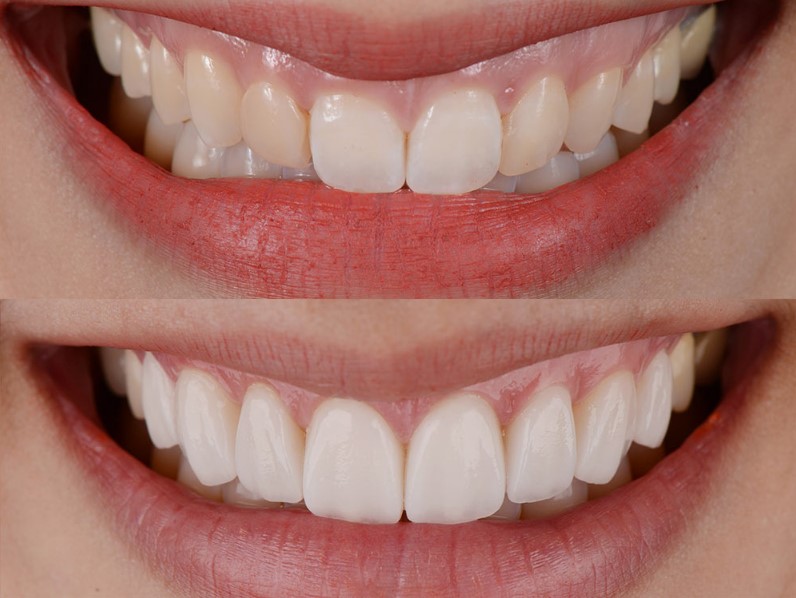 Dental veneers are placed on teeth surface in cosmetic dentistry.